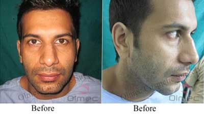 Olmec rhinoplasty case, before surgery