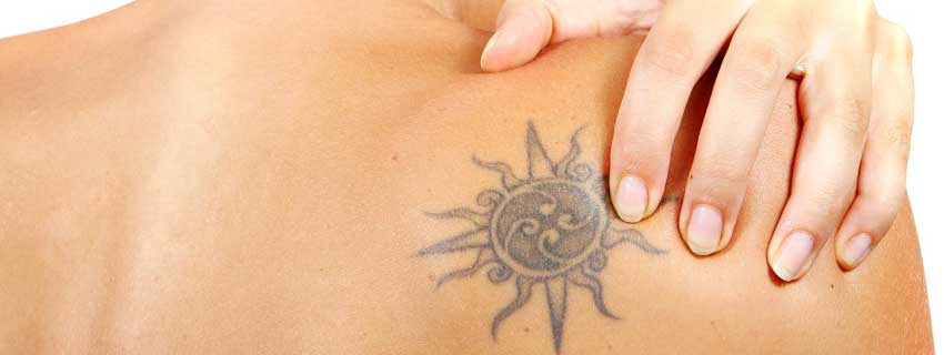 Permanent Tattoo Removal Surgery Delhi India