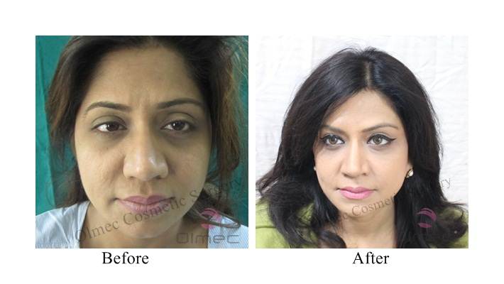 Before and After Facelift Surgery in Delhi