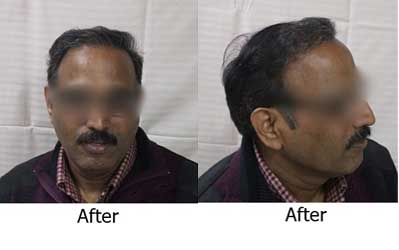 Recover Hair Transplant Centre  Kakkar Hospital Morinda   RecoverHairTransplant  Facebook  By Recover Hair Transplant Centre   Kakkar Hospital Morinda  RecoverHairTransplant Want to transform your life  with an effective